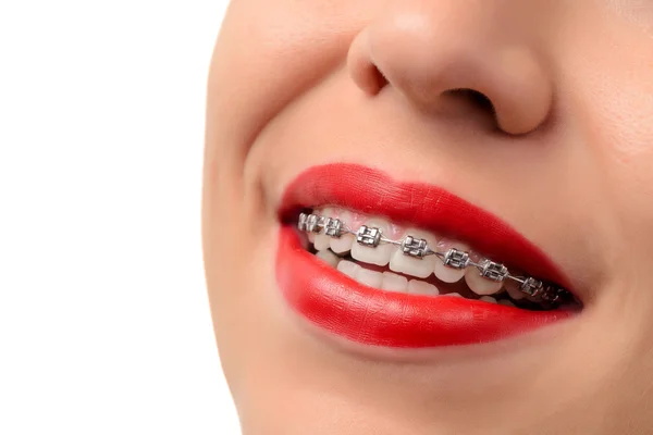 Female open mouth showing metal Braces — Stock Photo, Image