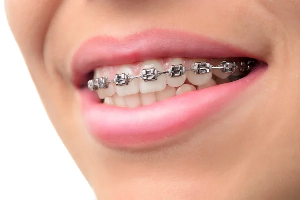 Nahaufnahme Zähne mit Zahnspange — Stockfoto
