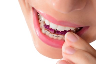 Kadın giyiyor ortodontik çıkarılabilir brac