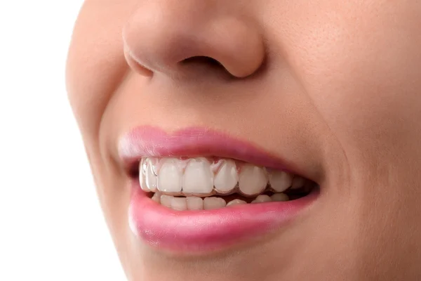 Dental medical care. Invisible braces Stock Image