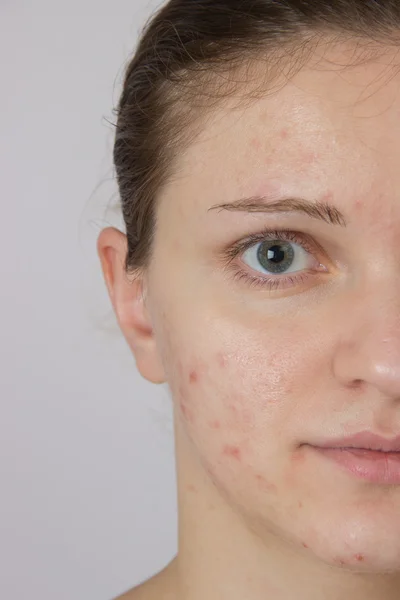 Mooi jong meisje met acne op zijn gezicht en de achterkant — Stockfoto