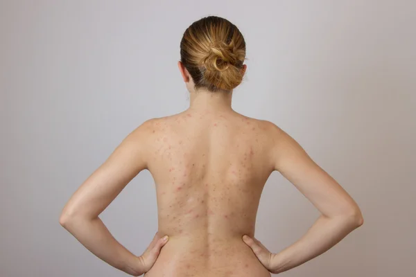 Arkadaki kırmızı lekeler ile sivilce ile genç kız