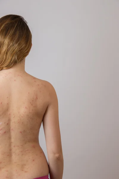 Jovem com acne, com manchas vermelhas nas costas — Fotografia de Stock