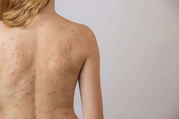 Jovem com acne, com manchas vermelhas nas costas — Fotografia de Stock