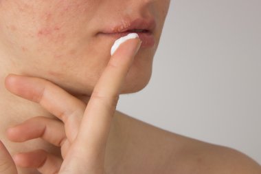Herpes irin bir genç kızın dudaklarında ve sivilce f ile