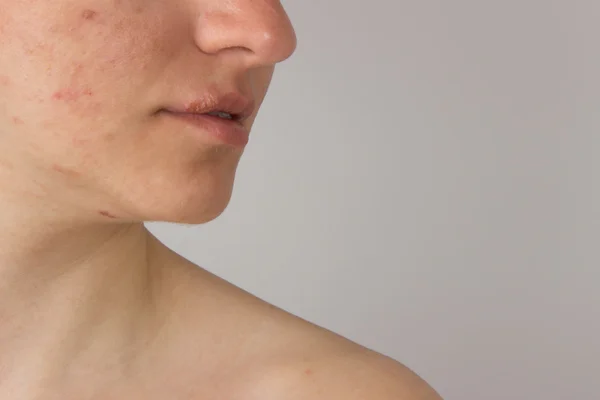 Herpes irin bir genç kızın dudaklarında ve sivilce f ile