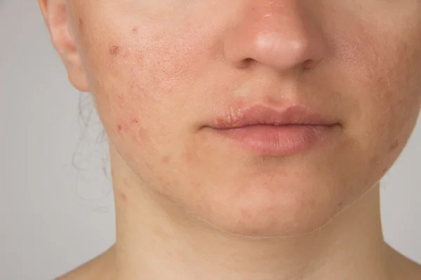 Herpes irin bir genç kızın dudaklarında ve sivilce f ile