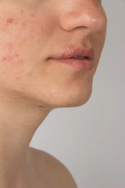 Herpes con pus en los labios de una joven y granos en la f —  Fotos de Stock