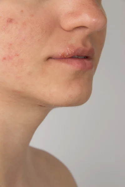 Herpes with pus on the lips of a young girl and pimples on the f — Stock Photo, Image