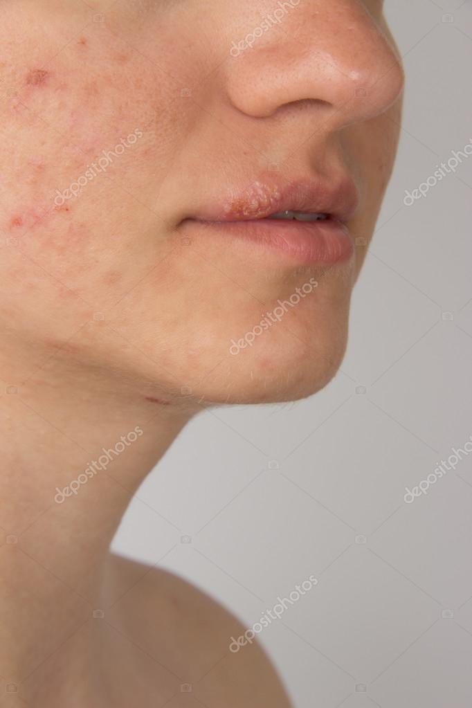 Herpes with pus on the lips of a young girl and pimples on the f Stock