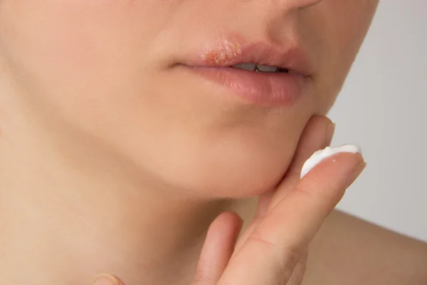 Herpes pijnlijke, met pus op de lippen van de mooie meisje en — Stockfoto