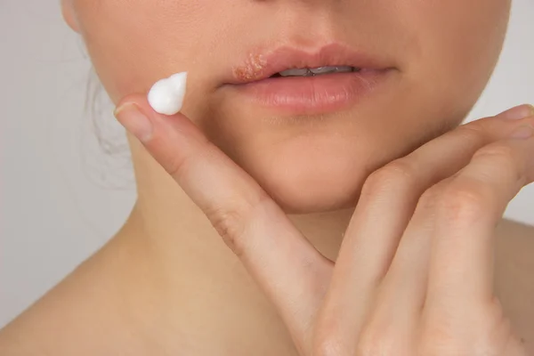 Herpes pijnlijke, met pus op de lippen van de mooie meisje en — Stockfoto