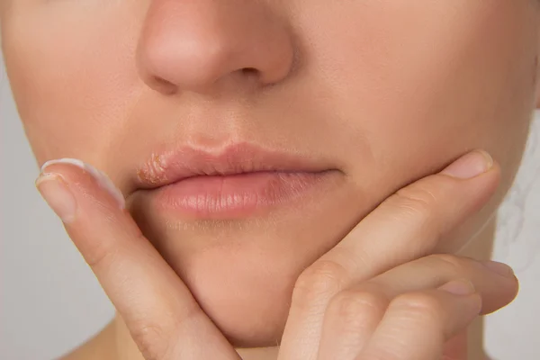 Herpes sore with pus on the lips of the young beautiful girl and — Stock Photo, Image