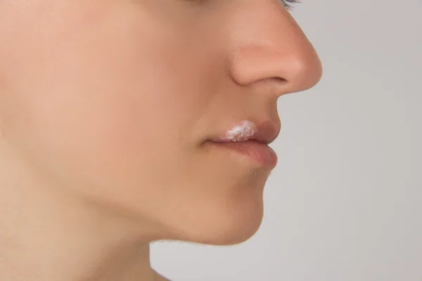 Herpes genç güzel kızı dudaktan irin ile boğaz ve