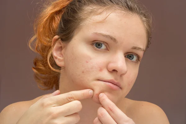 Portret van jonge mooie vrouw knijpen van acne of puistje isola — Stockfoto