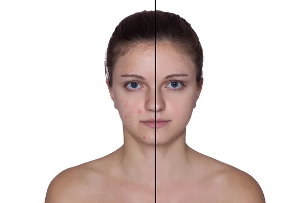 Portrait of a young beautiful girl with spots on half of the fac — Stock Photo, Image