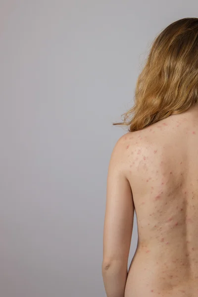 Young girl with acne, with red and white spots on the back