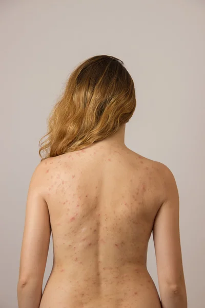 Chica joven con acné, con manchas rojas y blancas en la espalda —  Fotos de Stock