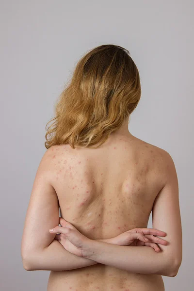 Jovem com acne, com manchas vermelhas e brancas nas costas — Fotografia de Stock