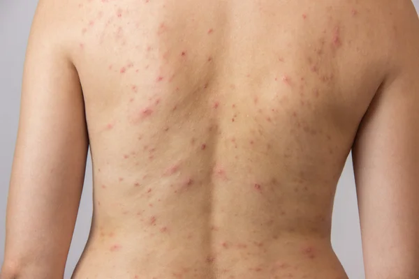 Jong meisje met acne, met rode en witte vlekken op de rug — Stockfoto