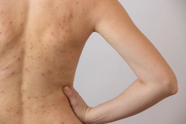 Jong meisje met acne, met rode en witte vlekken op de rug — Stockfoto