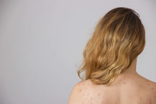 Jong meisje met acne, met rode en witte vlekken op de rug — Stockfoto