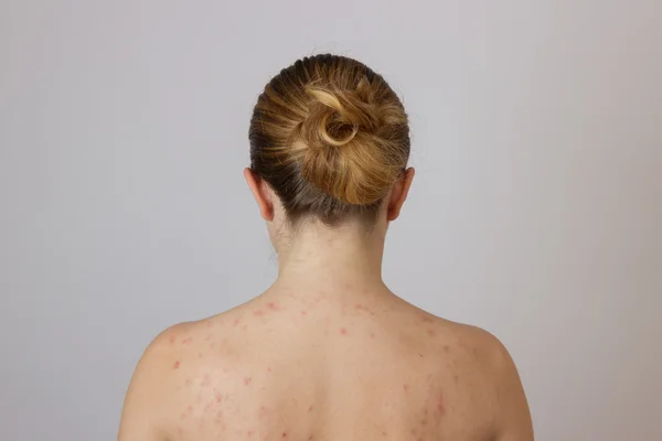 Jong meisje met acne, met rode en witte vlekken op de rug — Stockfoto