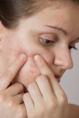 Onun yüzünde sivilce ve bir WHI arkasında güzel genç kızla