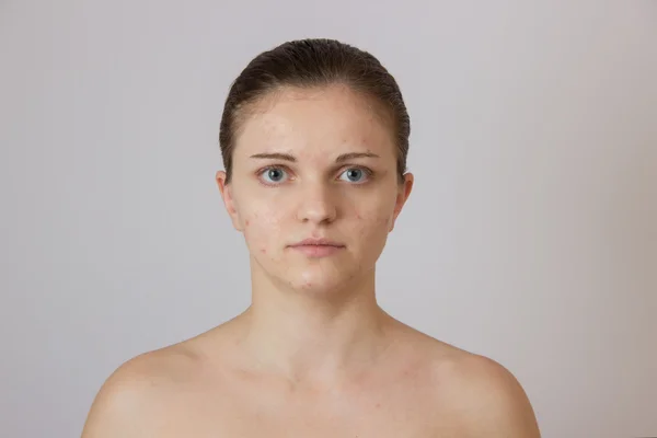 Beautiful young girl with acne on his face and the back on a whi — Stock Photo, Image