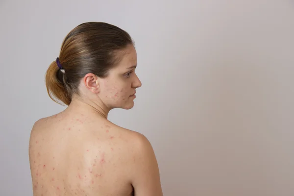 Beautiful young girl with acne on his face and the back on a whi — Stock Photo, Image