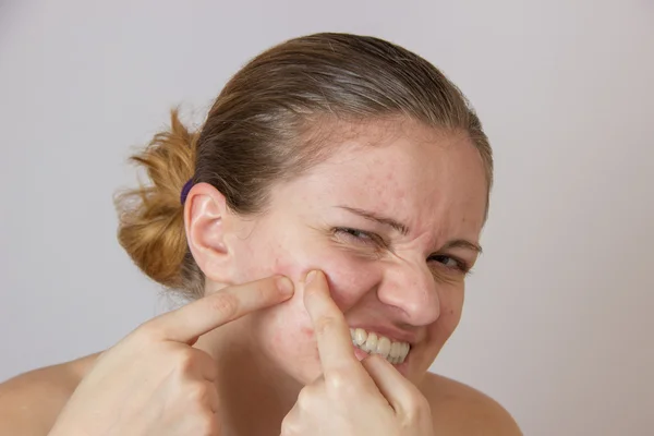 Menina bonita com acne em seu rosto e as costas em um whi — Fotografia de Stock
