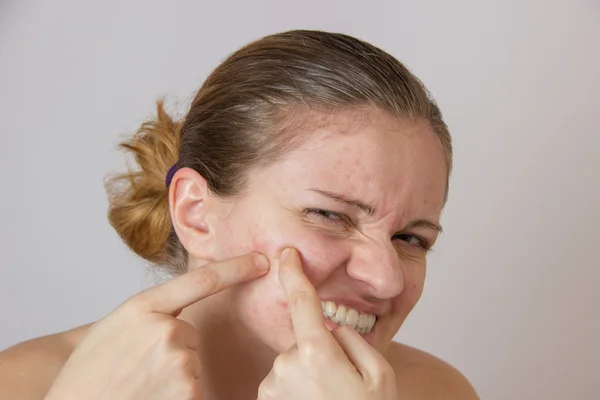 Beautiful young girl with acne on his face and the back on a whi — Stock Photo, Image