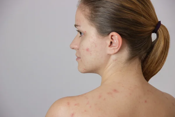 Beautiful young girl with acne on his face and the back on a whi — Stock Photo, Image