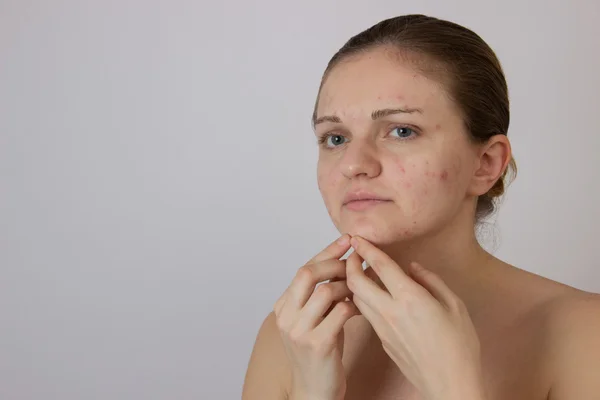 Hermosa joven con acné en la cara y la espalda en un whi — Foto de Stock