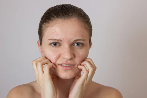 Beautiful young girl with acne on his face and the back on a whi — Stock Photo, Image