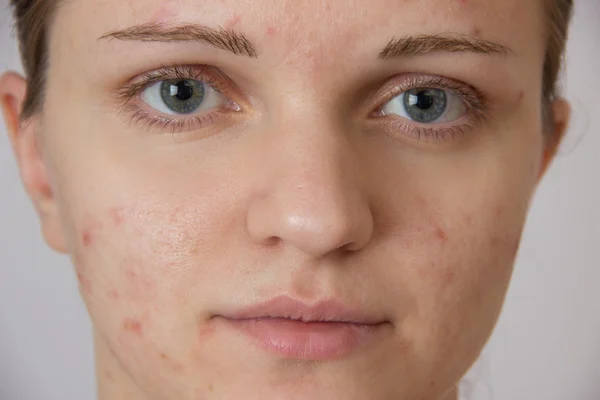 Mooi jong meisje met acne op zijn gezicht en de achterkant op een whi — Stockfoto