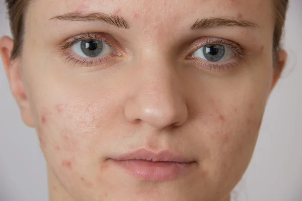 Beautiful young girl with acne on his face and the back on a whi — Stock Photo, Image