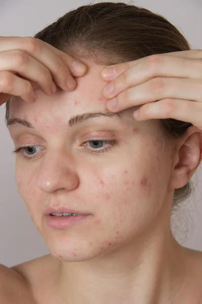 Hermosa joven con acné en la cara y la espalda en un whi —  Fotos de Stock