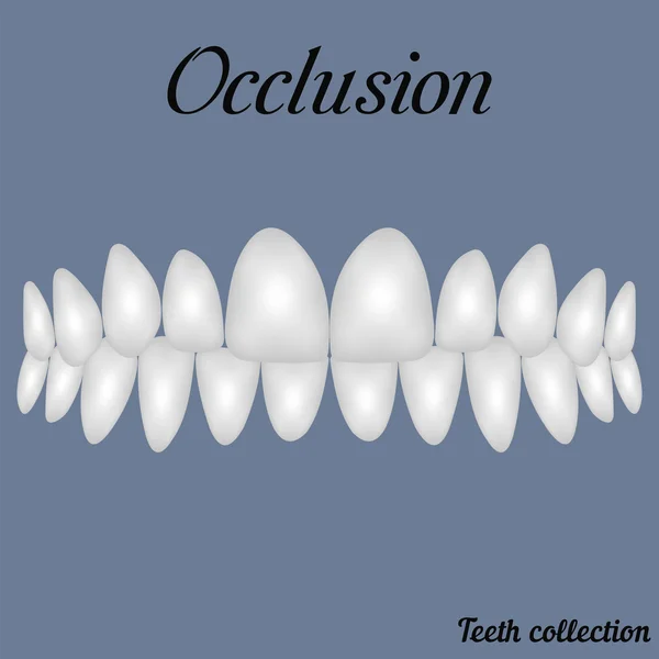 Occlusie gebalde tanden — Stockvector