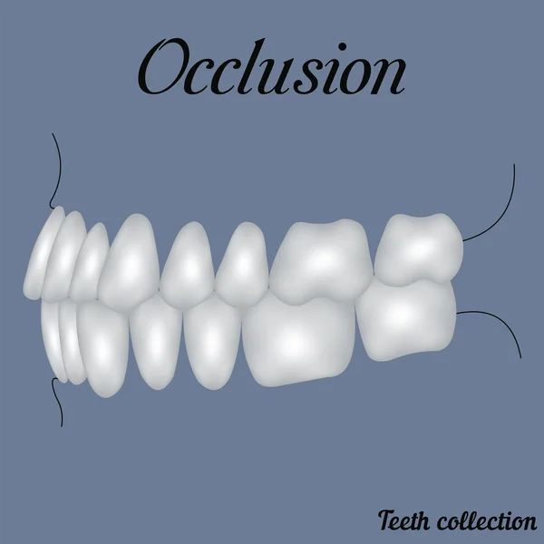 Ocklusion sidovy — Stock vektor