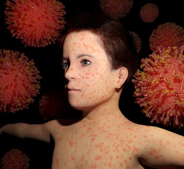 Measles Return