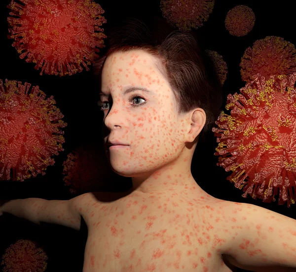 Measles Return — 스톡 사진