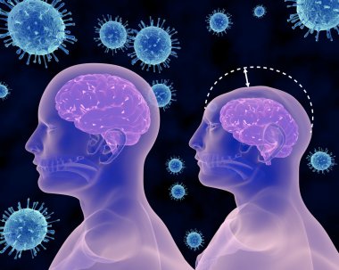 Zika virüs ve Microcephaly