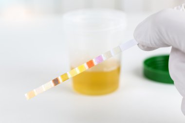 Medical urine test with urine test strips, close up clipart