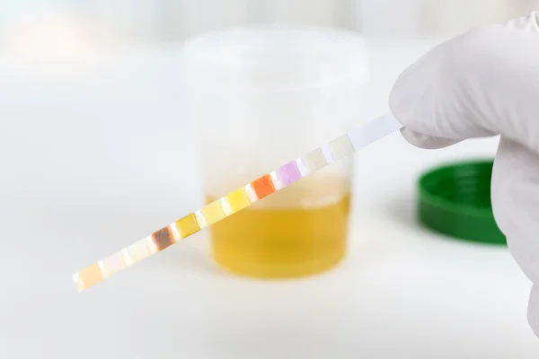 Medische urinetest met urine test strips, close-up — Stockfoto