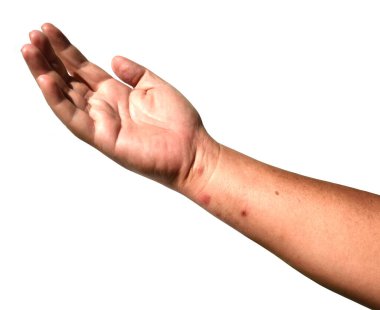 İnsan kolunda ve elinde kızarıklıklar ve kırmızı kabarcıklar beyaz arka planda, böcek zehrinden kaynaklanan tahriş alerji ve virüsten kaynaklanıyor.
