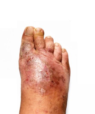 İnsan ayağı, beyaz arka planda izole edilmiş bir mantar derisi lezyonudur. Sporcuların ayağı, dermatophyte veya Tinea pedis, Canadian Albicans. 