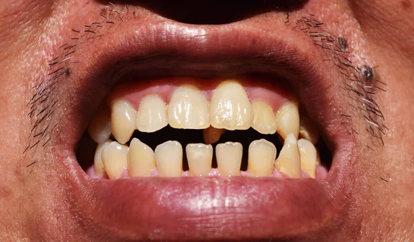 Gros Plan Sur Rangée Dents Avec Une Tache Jaune Distance — Photo