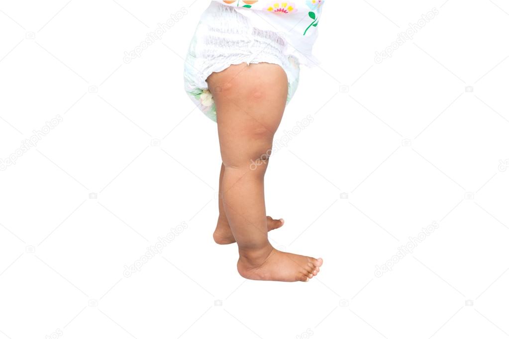 new born with multiple mosquito bites on leg, white background,w