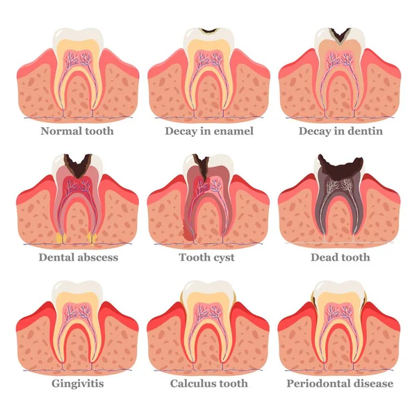 Conjunto de trastornos dentales, ilustración vectorial plana. Dientes sanos y poco saludables. Problemas y enfermedades dentales. — Vector de stock